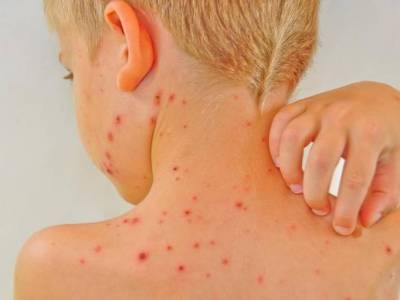 KNOW THE RISKS OF CHICKEN POX