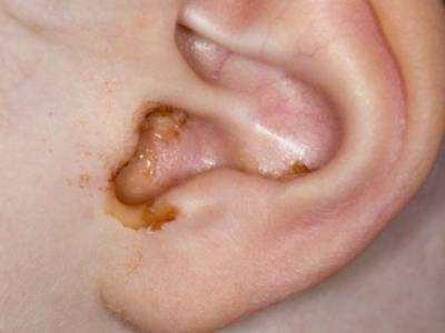 ear wax