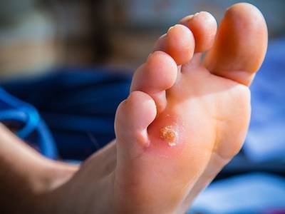 foot corns
