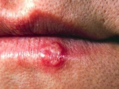 Herpes