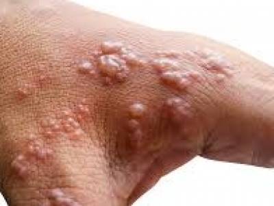 PREVENTING SHINGLES