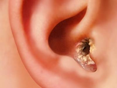Swimmer's ear